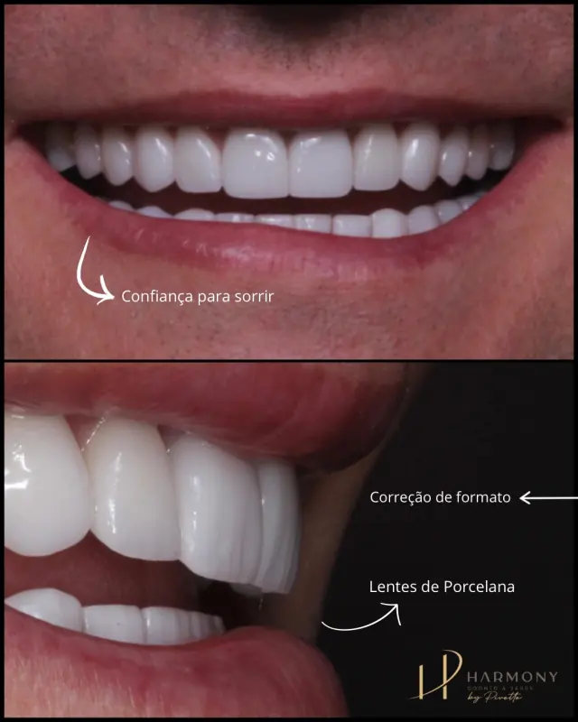 Antes e depois de lentes de contato dental: sorriso de frente e de perfil